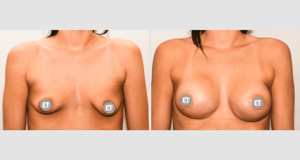 Vorher/Nachher Ergebnis: Mammatubulaere Deformitaet