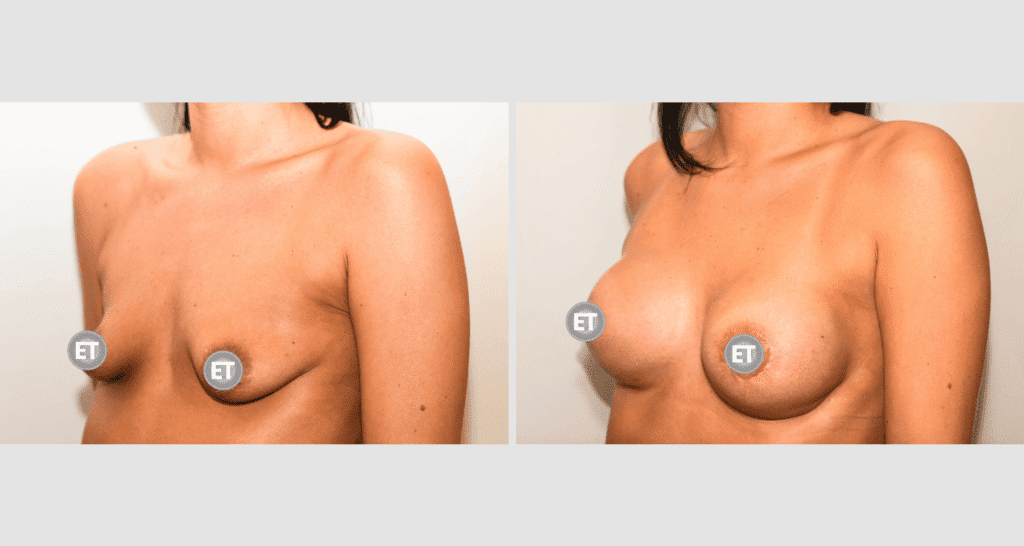 Vorher/Nachher Ergebnis: Mammatubulaere Deformitaet