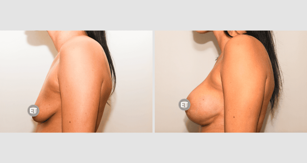 Vorher/Nachher Ergebnis: Mammatubulaere Deformitaet