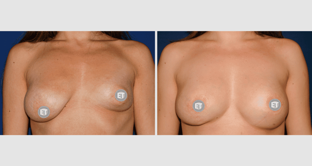 Vorher/Nachher Ergebnis: Mammatubulaere Deformitaet