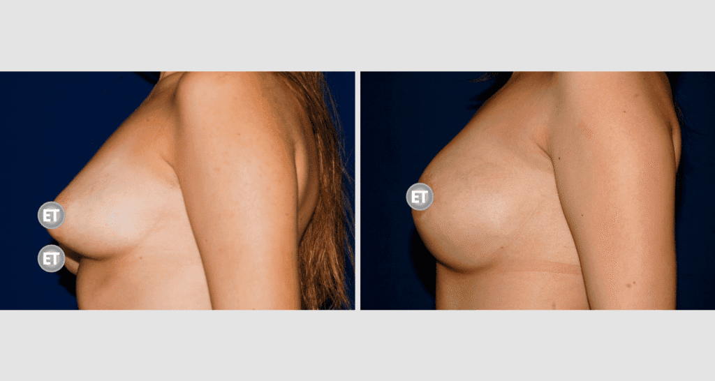 Vorher/Nachher Ergebnis: Mammatubulaere Deformitaet