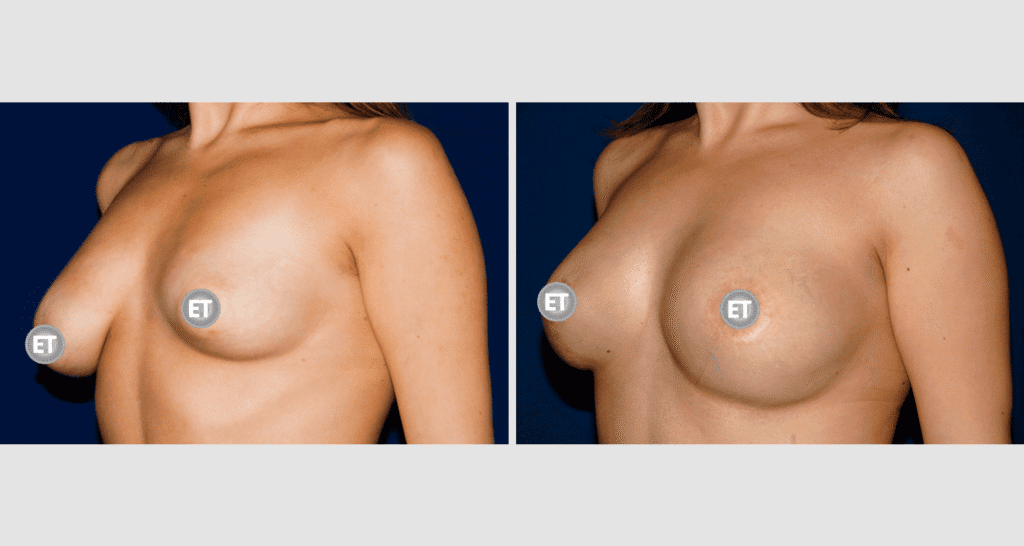 Vorher/Nachher Ergebnis: Mammatubulaere Deformitaet