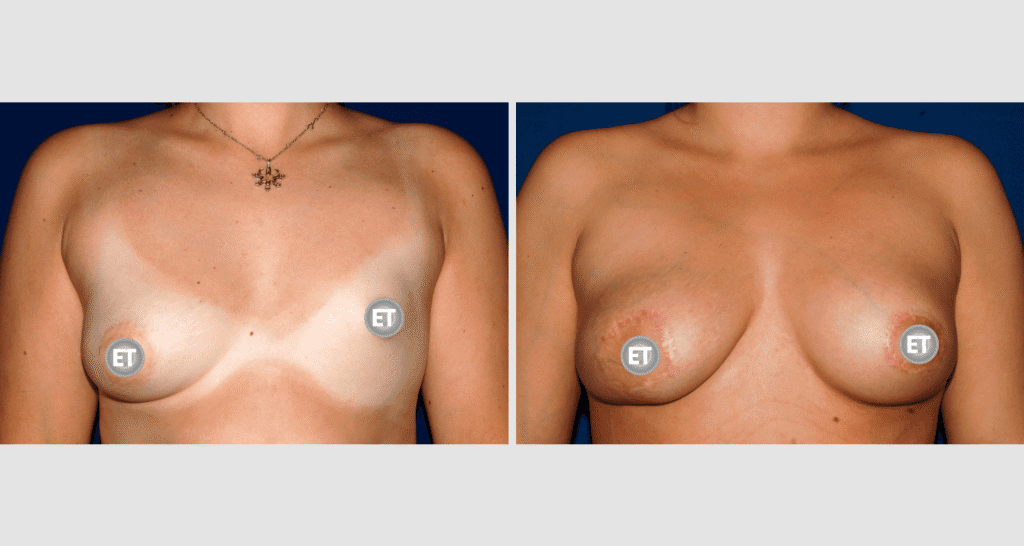 Vorher/Nachher Ergebnis: Mammatubulaere Deformitaet