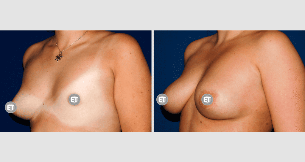 Vorher/Nachher Ergebnis: Mammatubulaere Deformitaet