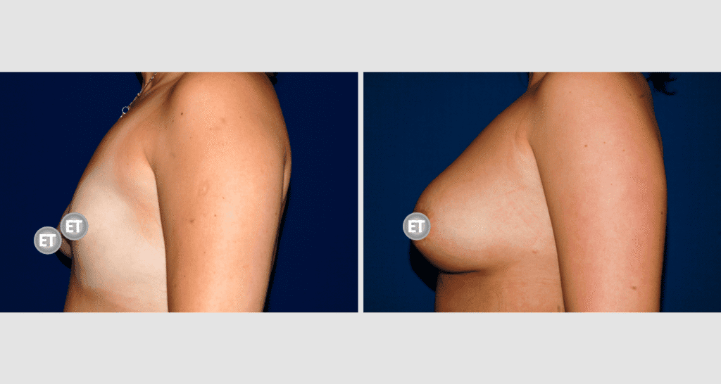 Vorher/Nachher Ergebnis: Mammatubulaere Deformitaet