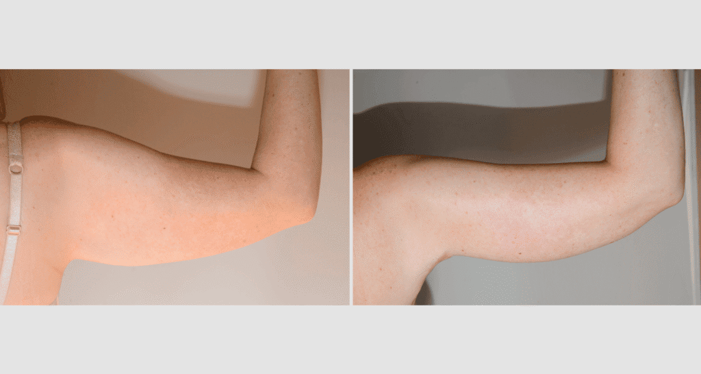 Vorher/Nachher Ergebnis: Oberarmstraffung