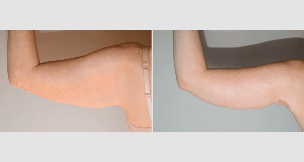 Vorher/Nachher Ergebnis: Oberarmstraffung