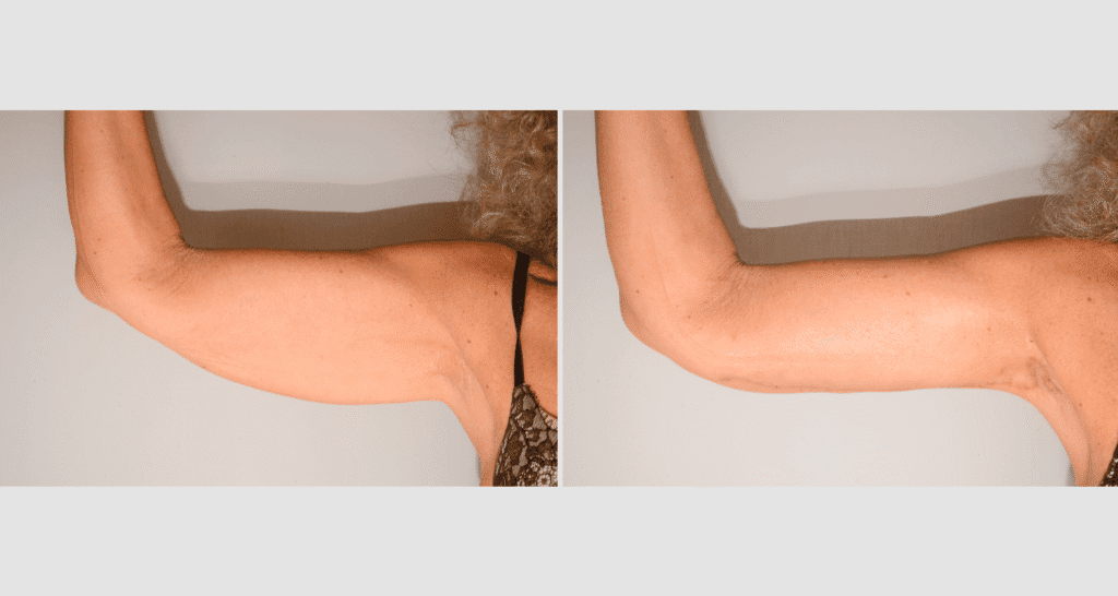 Vorher/Nachher Ergebnis: Oberarmstraffung