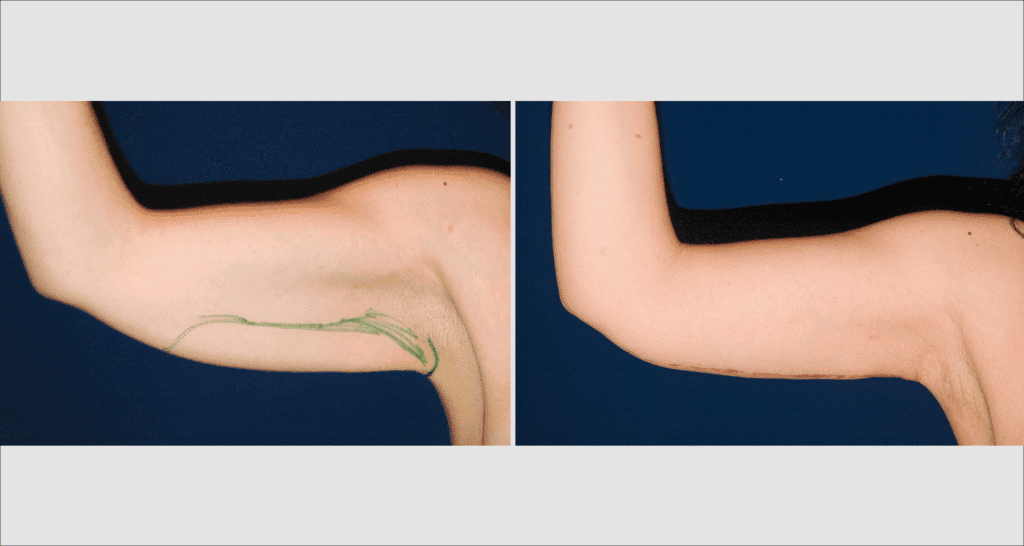 Vorher/Nachher Ergebnis: Oberarmstraffung