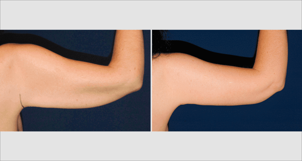 Vorher/Nachher Ergebnis: Oberarmstraffung