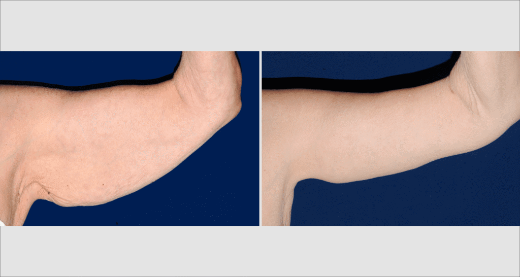 Vorher/Nachher Ergebnis: Oberarmstraffung