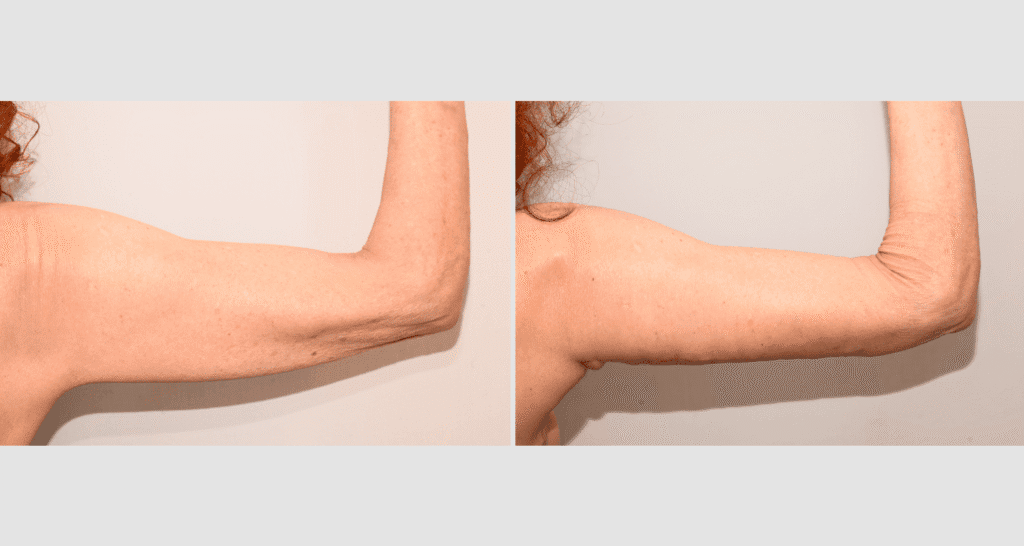 Vorher/Nachher Ergebnis: Oberarmstraffung