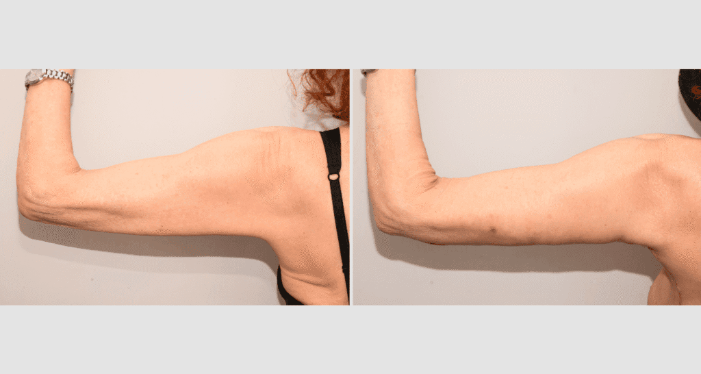 Vorher/Nachher Ergebnis: Oberarmstraffung