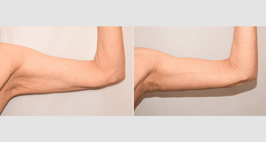 Vorher/Nachher Ergebnis: Oberarmstraffung