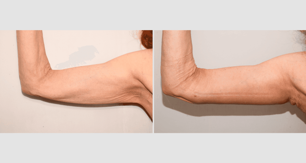 Vorher/Nachher Ergebnis: Oberarmstraffung