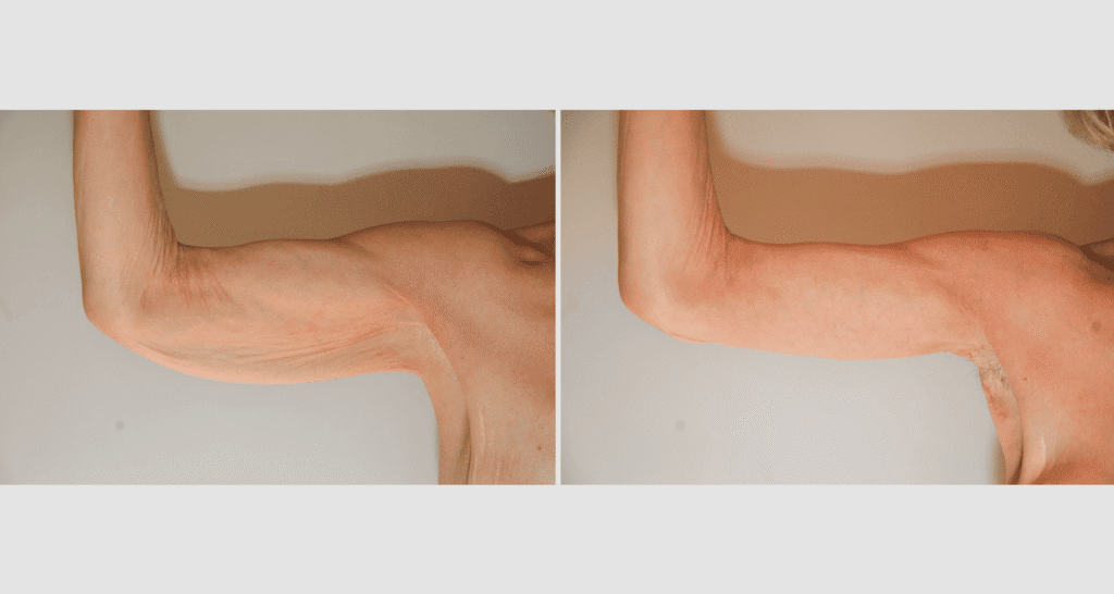 Vorher/Nachher Ergebnis: Oberarmstraffung