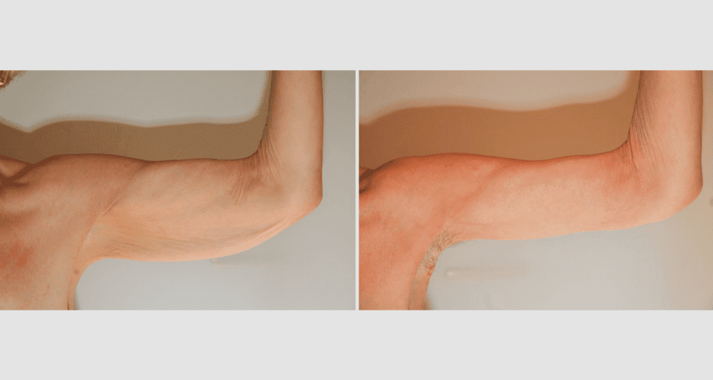 Vorher/Nachher Ergebnis: Oberarmstraffung