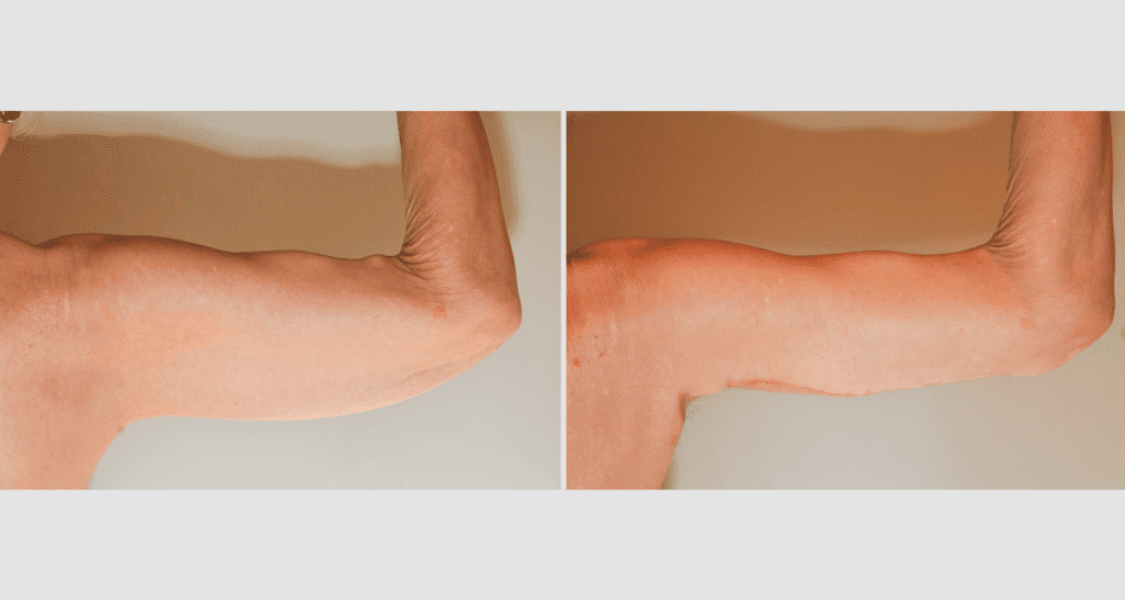 Vorher/Nachher Ergebnis: Oberarmstraffung