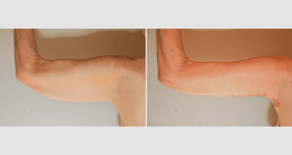 Vorher/Nachher Ergebnis: Oberarmstraffung