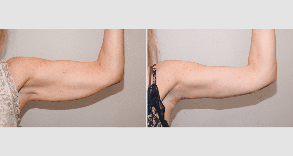 Vorher/Nachher Ergebnis: Oberarmstraffung