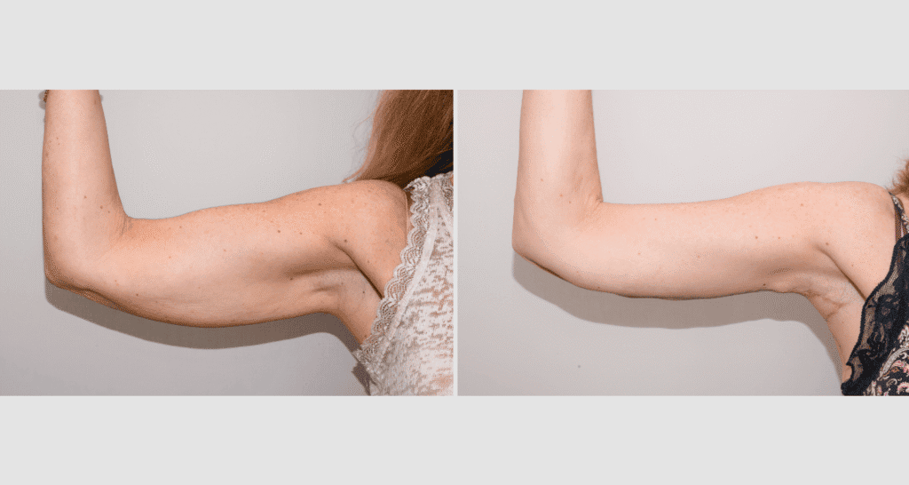 Vorher/Nachher Ergebnis: Oberarmstraffung