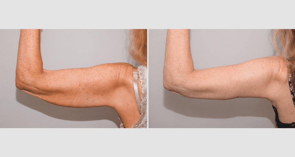 Vorher/Nachher Ergebnis: Oberarmstraffung
