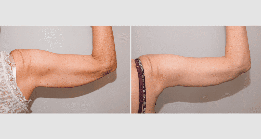Vorher/Nachher Ergebnis: Oberarmstraffung