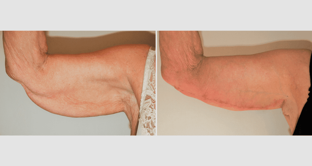 Vorher/Nachher Ergebnis: Oberarmstraffung