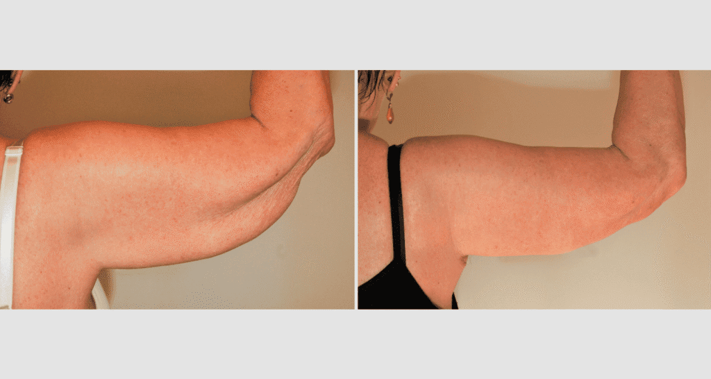 Vorher/Nachher Ergebnis: Oberarmstraffung