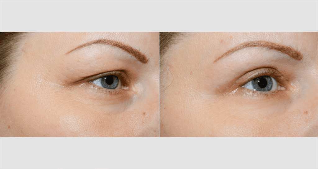 Vorher/Nachher Ergebnis: Oberlid Unterlidstaffung