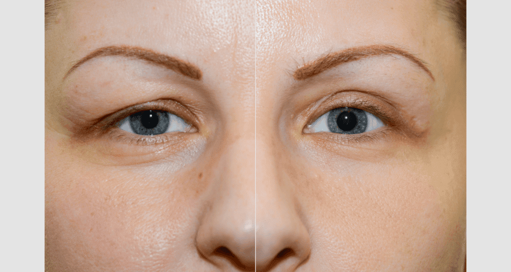 Vorher/Nachher Ergebnis: Oberlid Unterlidstaffung