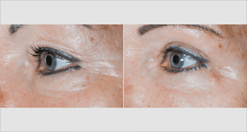 Vorher/Nachher Ergebnis: Oberlid Unterlidstaffung