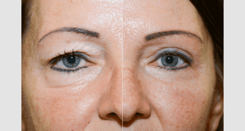 Vorher/Nachher Ergebnis: Oberlid Unterlidstaffung