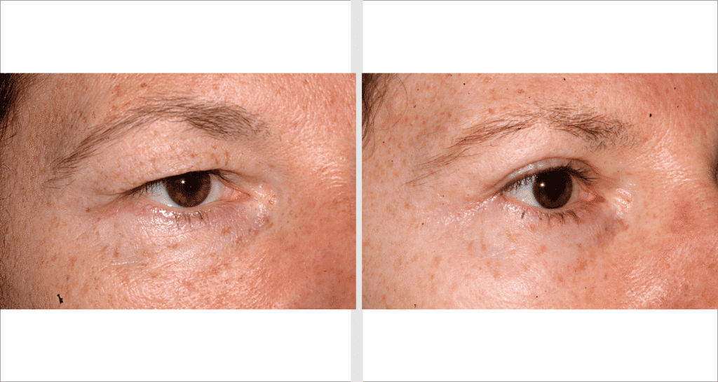 Vorher/Nachher Ergebnis: Oberlid Unterlidstaffung