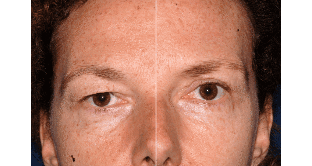 Vorher/Nachher Ergebnis: Oberlid Unterlidstaffung