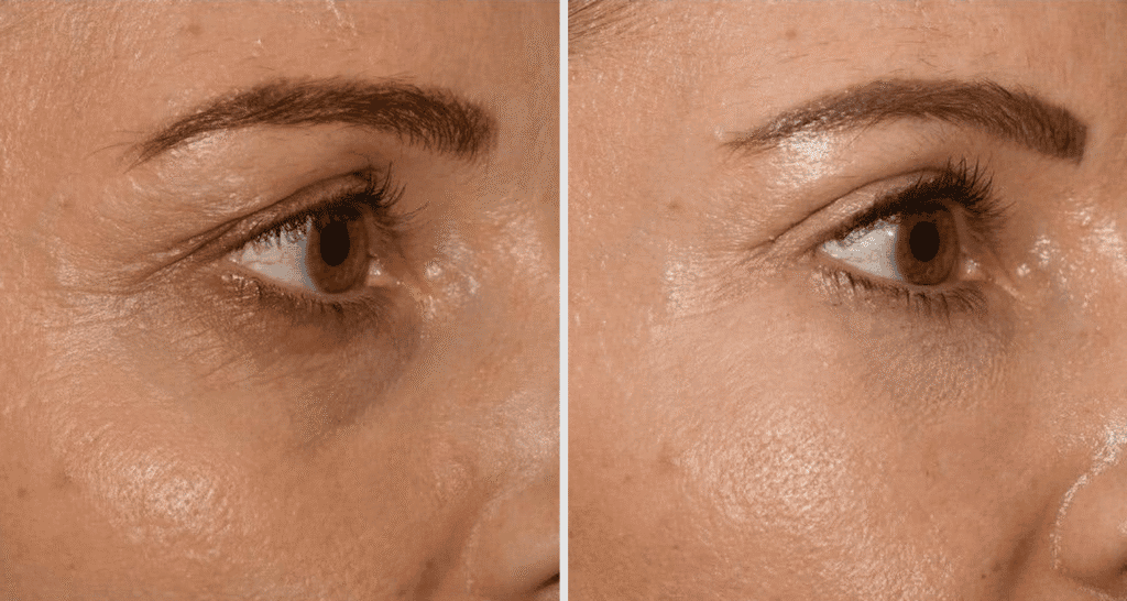 Vorher/Nachher Ergebnis: Oberlid Unterlidstaffung