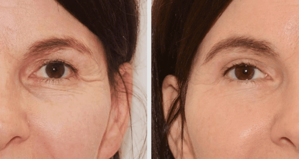 Vorher/Nachher Ergebnis: Oberlid Unterlidstaffung