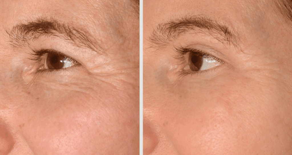 Vorher/Nachher Ergebnis: Oberlid Unterlidstaffung