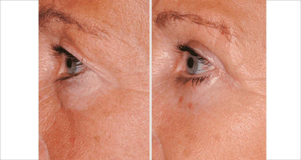Vorher/Nachher Ergebnis: Oberlid Unterlidstaffung