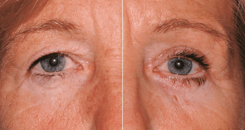 Vorher/Nachher Ergebnis: Oberlid Unterlidstaffung