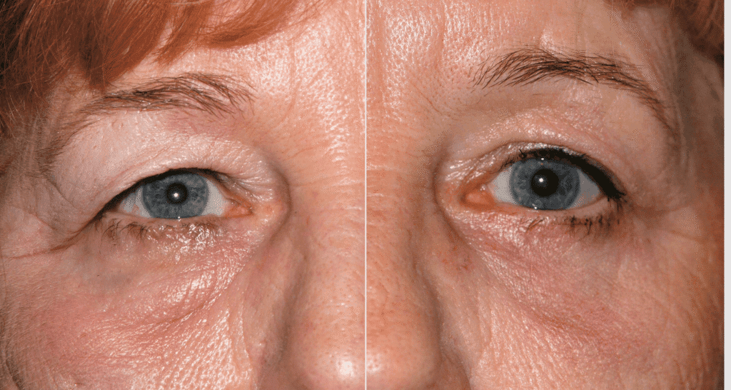 Vorher/Nachher Ergebnis: Oberlid Unterlidstaffung