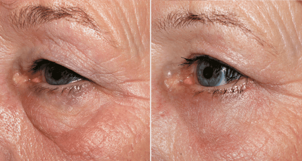 Vorher/Nachher Ergebnis: Oberlid Unterlidstaffung