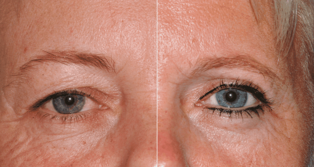 Vorher/Nachher Ergebnis: Oberlid Unterlidstaffung