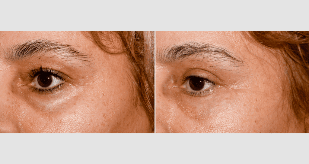 Vorher/Nachher Ergebnis: Oberlid Unterlidstaffung