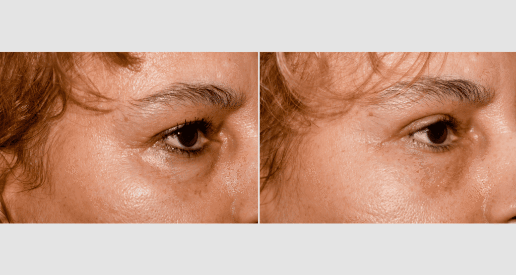 Vorher/Nachher Ergebnis: Oberlid Unterlidstaffung