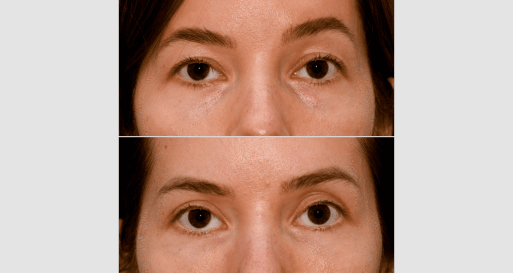 Vorher/Nachher Ergebnis: Oberlid Unterlidstaffung