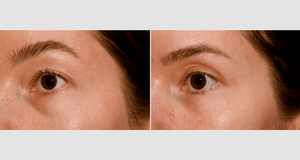 Vorher/Nachher Ergebnis: Oberlid Unterlidstaffung