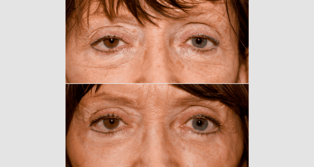 Vorher/Nachher Ergebnis: Oberlid Unterlidstaffung