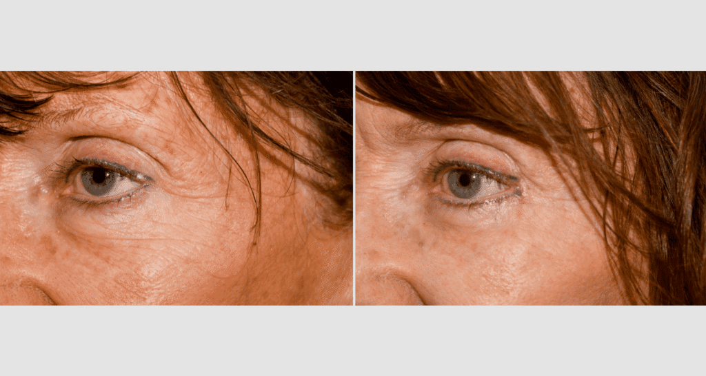 Vorher/Nachher Ergebnis: Oberlid Unterlidstaffung