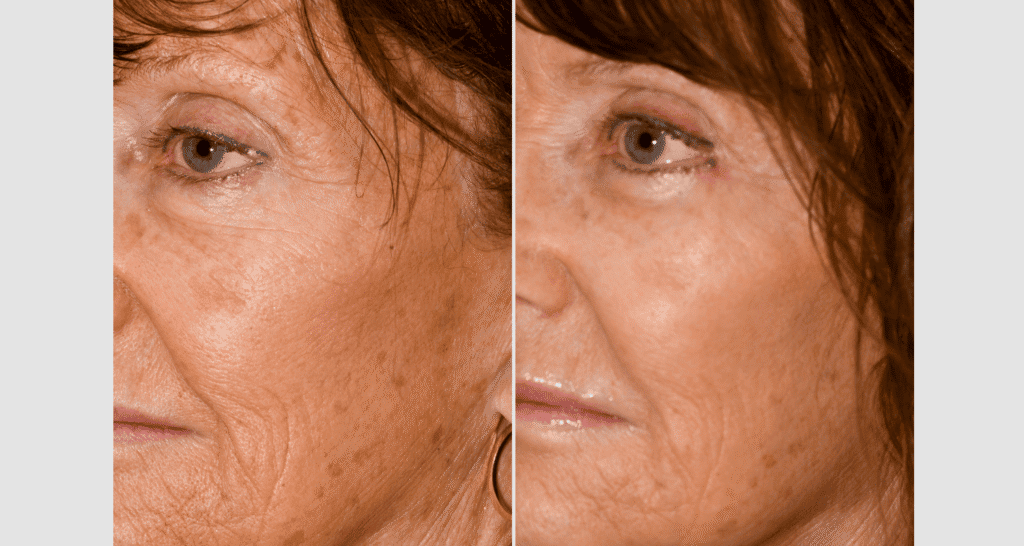 Vorher/Nachher Ergebnis: Oberlid Unterlidstaffung